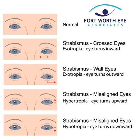 Strabismus Surgery for Misaligned Eyes, Crossed Eyes, or Wall Eyes