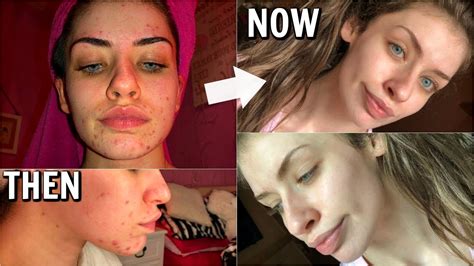 How I Cleared My Skin Naturally My Hormonal Acne Journey And Skincare