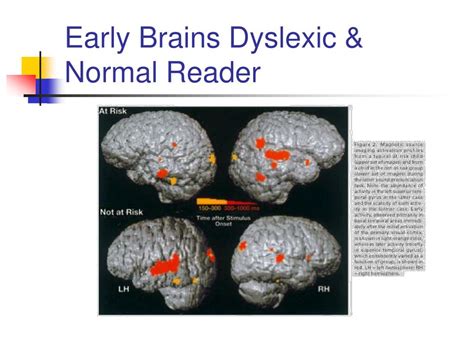 Ppt Dyslexia And The Brain Powerpoint Presentation Free Download