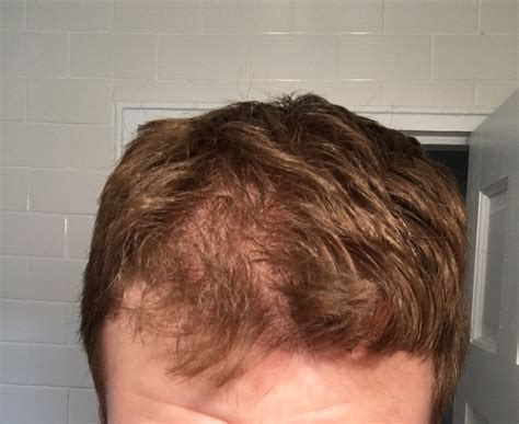 3 years on Fin, hair thinning heavily on one side. Input is greatly