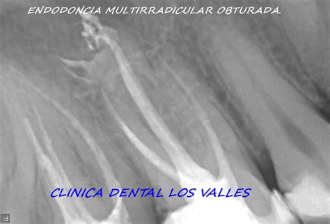 Necrosis dental o pulpar Tipos y tratamiento Qué es la necrosis