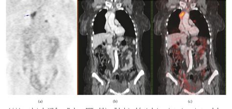 Figure 1 From Unusual Case Of Superior Vena Cava Syndrome Caused By