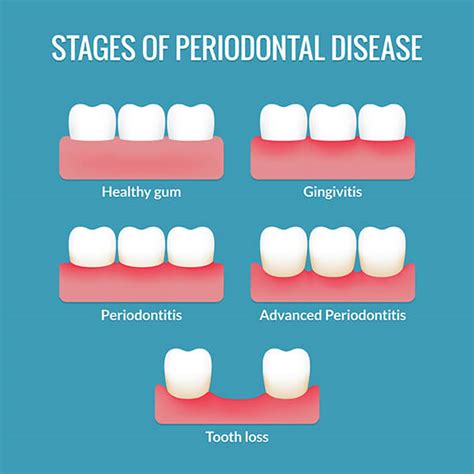 Gum Disease Camden Hills Dental Care