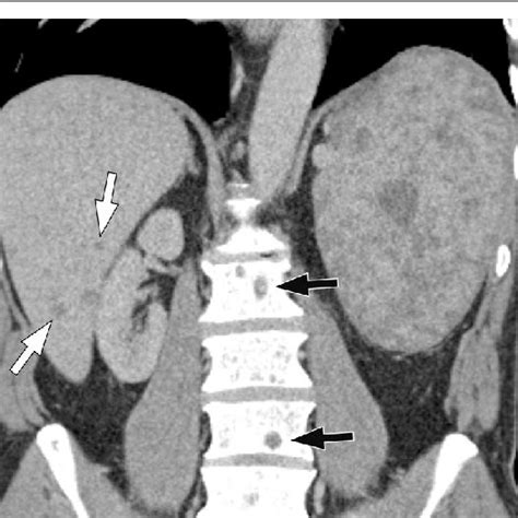 79 Year Old Woman With Radiation Associated Angiosarcoma Of The Breast