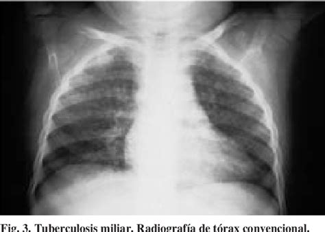 Figure From Manifestaciones Radiol Gicas De La Tuberculosis Pulmonar