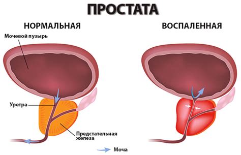 Физиотерапия при простатите: виды и польза процедур