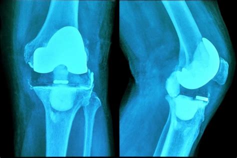 Cuidados y ejercicios tras la cirugía de prótesis de rodilla