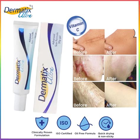 Dermatix Ultra Remover Scar Repair Cream Advance Scar Stretch Acne