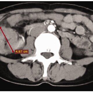 Abdominal Contrast Enhanced Computed Tomography CT Horizontal View