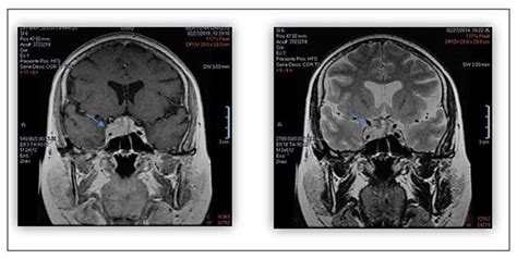 Nuclear Magnetic Resonance Images Of The Sellar Region Coronal T1