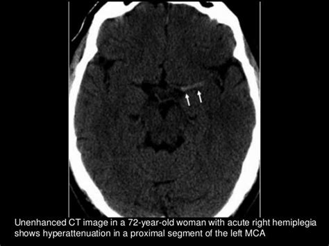 Non Hemorrhagic Ischemic Stroke Imaging