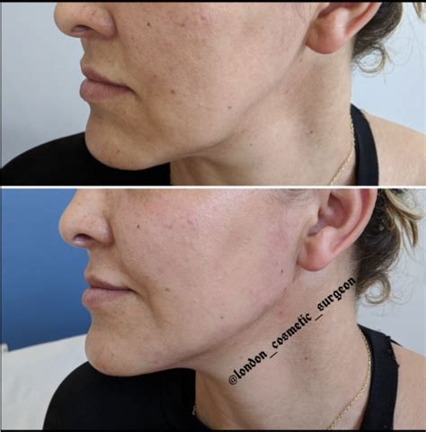 Thread Lifts With Intracel Derma Revive Skin Clinic