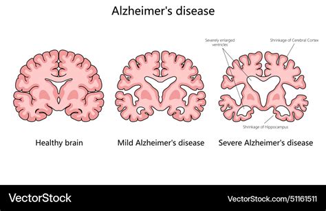 Progression of alzheimer disease in brain diagram Vector Image