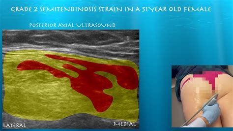 Ultrasound Of Grade 2 Semitendinosis Hamstring Strain In A 51 Year Old Female Youtube