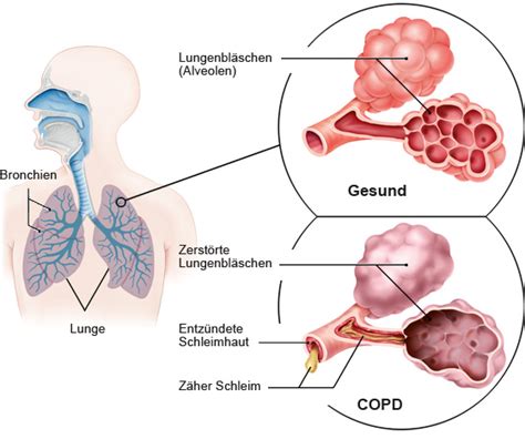 Chronisch Obstruktive Lungenerkrankung COPD UPD