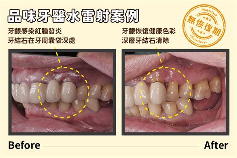 水雷射無痛治療牙周病，怕痛不用瑟瑟發抖 新竹品味牙醫