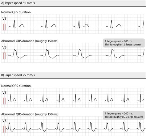 Figure 26. Normal and abnormal QRS durations at different paper speeds ...