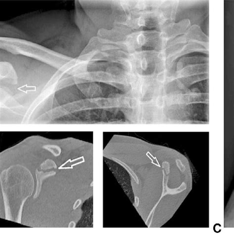 A The Coracoid Process And Its Attached Anatomical Structures Superior Download Scientific