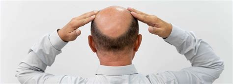 Male Pattern Baldness Causes Effects And Treatments