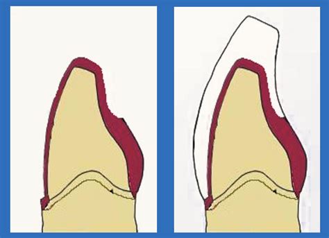 Substructures For Tooth Born Fixed Prosthesis Flashcards Quizlet