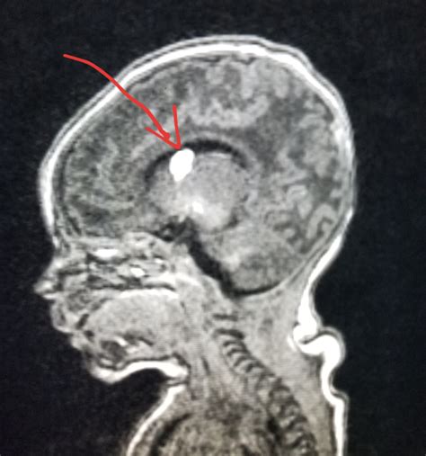 #Brain #MRI: 8 day old with a #bleed (#germinal matrix #hemorrhage). # ...