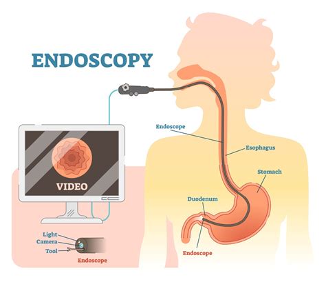 Gastroscopy Procedure And Cost Singapore 2024 Nexus Surgical