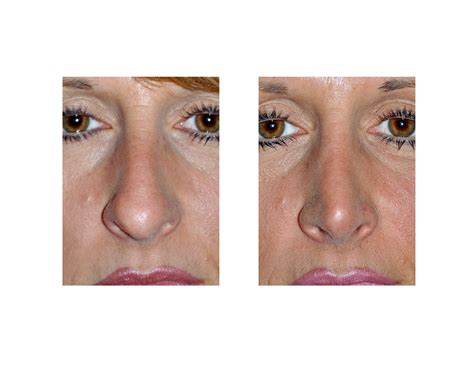 The Cephalic Trim In Tip Rhinoplasty Explore Plastic Surgery