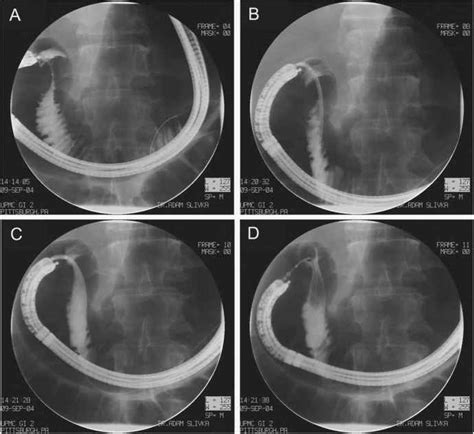 Technique Of Enteral Stenting Gastric Cancer