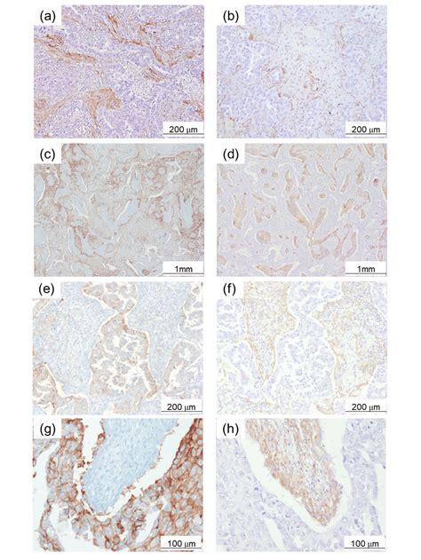 Expression Of α Smooth Muscle Actin α Sma In Lung Adenocarcinoma Download Scientific Diagram