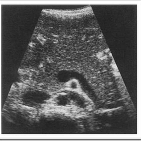 Normal Ultrasound Images Of Pancreas Pediatric Radiology Imaging