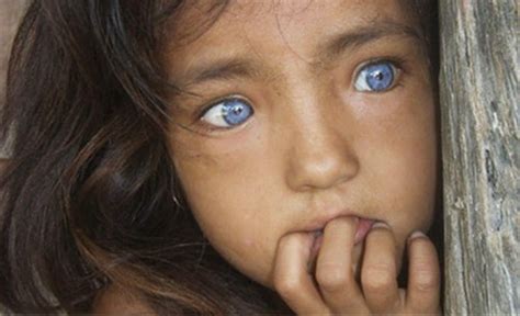 Waardenburg Syndrome | Waardenburg, Cool eyes, Blue eyes