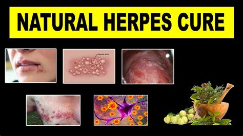 Herpes Cure 2018 Updates Holistic Cure For Herpes Youtube