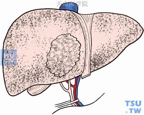 【附图】 肝中叶切除术 外科手术学 天山医学院