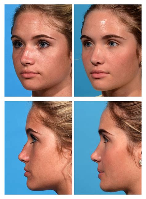 Rhinoplasty Before And After Photos