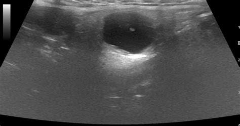 First Branchial Cleft Cyst Image