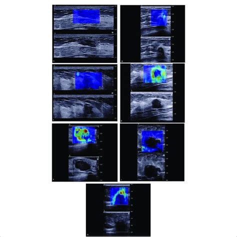 The Color Pattern Features Of Shear Wave Elastography A No Download Scientific Diagram