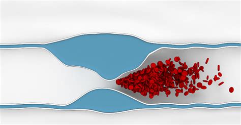 Heart Valve Disease