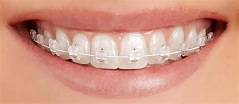 Self Ligating Braces Info And Costs About This Orthodontic Procedure