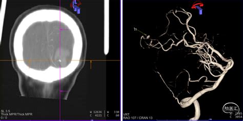 Tethys®中间导引导管辅助下行jama技术治疗左侧大脑后皮质段动脉瘤一例 脑医汇 神外资讯 神介资讯