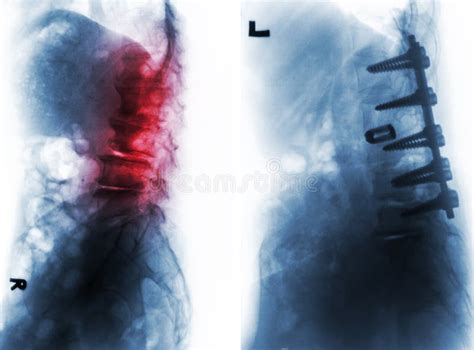 Spondylosis . before and after Surgery . Stock Image - Image of bone ...