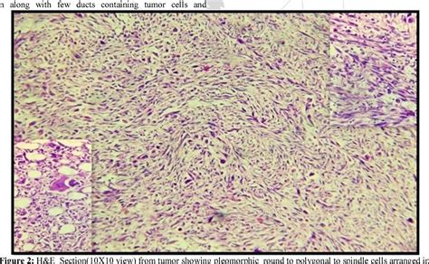 Figure 1 From Metaplastic Breast Carcinoma A Case Report With Review Of Literature Semantic