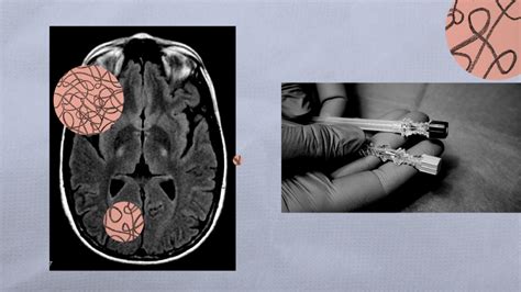 ALS Treatment FDA Approves Drug Toferson For One Type Of The Disease