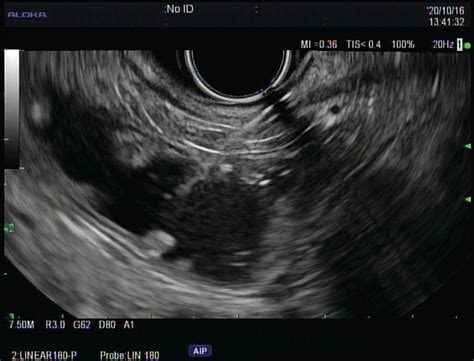 How To Do An Eus‐guided Gastrojejunostomy Radiology Key