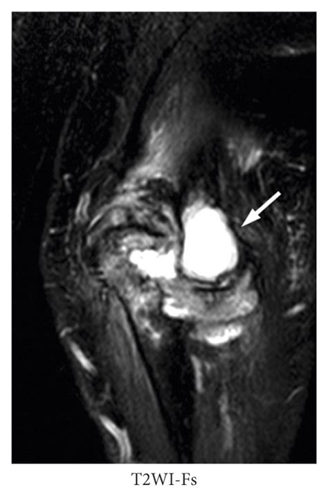 Magnetic Resonance Imaging Of The Left Elbow Obtained At The First