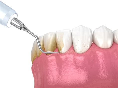 Scaling Root Planing Lakewood Dental Associates