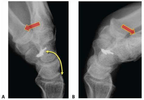 Capsulodesis For Treatment Of Scapholunate Instability