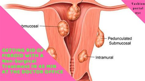 How To Get Rid Of Fibroid Without Surgery At The Doctor The Procedure Took 45 Min Healthy