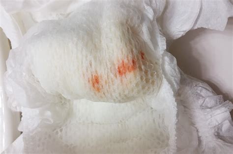 Uric Acid Crystals Diaper