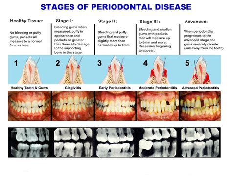 Perio Diagnosis Chart Grade Periodontitis Staging And Gradin