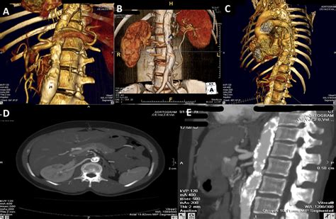 Computed tomography (CT) aortogram of abdomen | Download Scientific Diagram